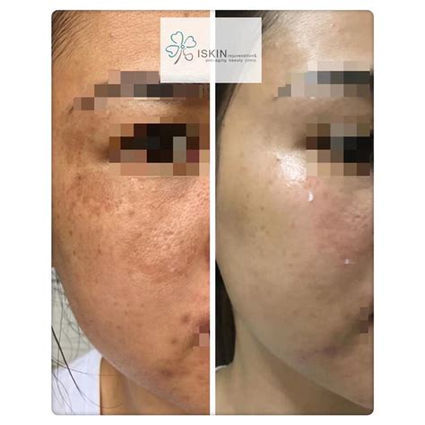 dermatologist in roxas city capiz|iSKIN Dermatology & Laser Center .